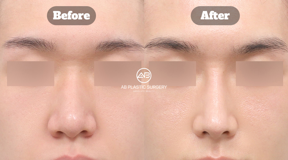 韓国で行われる男性向け鼻整形において、鷲鼻と曲がった鼻を同時に矯正し、骨格バランスと正面・横顔の印象がどのように改善されたかを示す前後比較画像