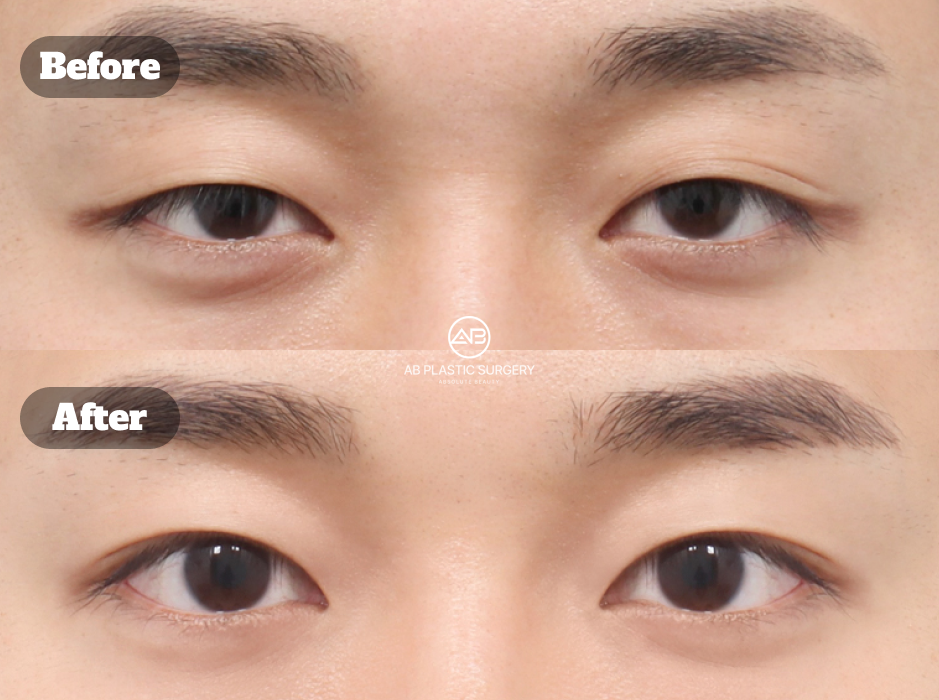 韓国の男性非切開目つき矯正のビフォーアフターレビューイメージ｜AB美容外科韓国