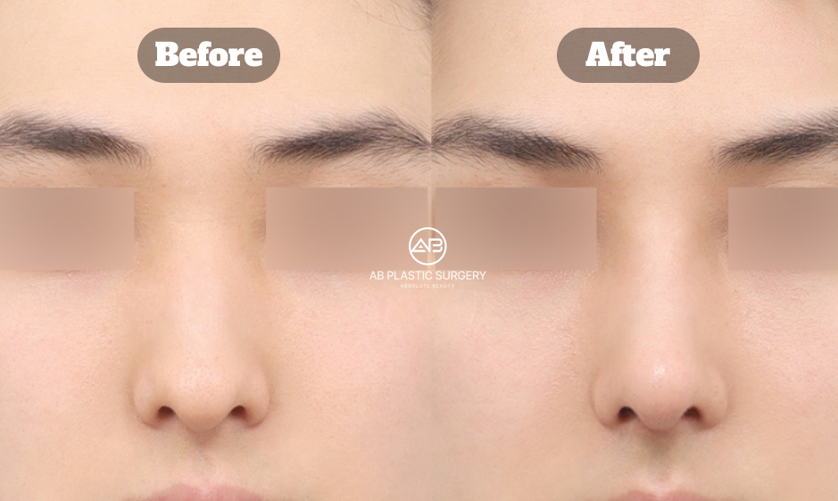 韓国の美容外科で行う男性のワシ鼻・曲がった鼻・団子鼻整形のビフォーアフターイメージ｜AB美容外科韓国