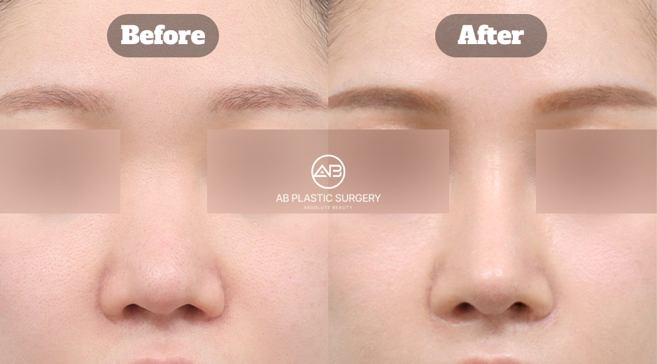 韓国で行われた曲がった鼻の再手術において、初回手術後に残った歪みをどのように修正し、前後写真と実際のレビューから改善過程を確認できる症例イメージ