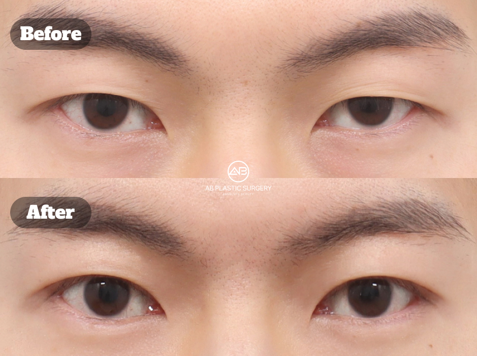 韓国の美容外科で行う男性二重まぶた手術のビフォーアフター写真｜AB美容外科韓国