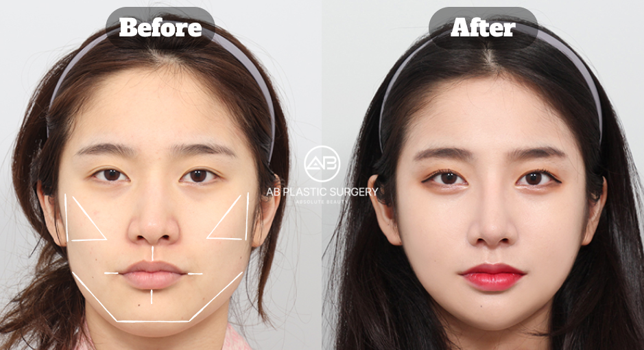 過度な変化を避け、個人差を踏まえて判断するミニVライン形成の考え方を示すビフォーアフター画像