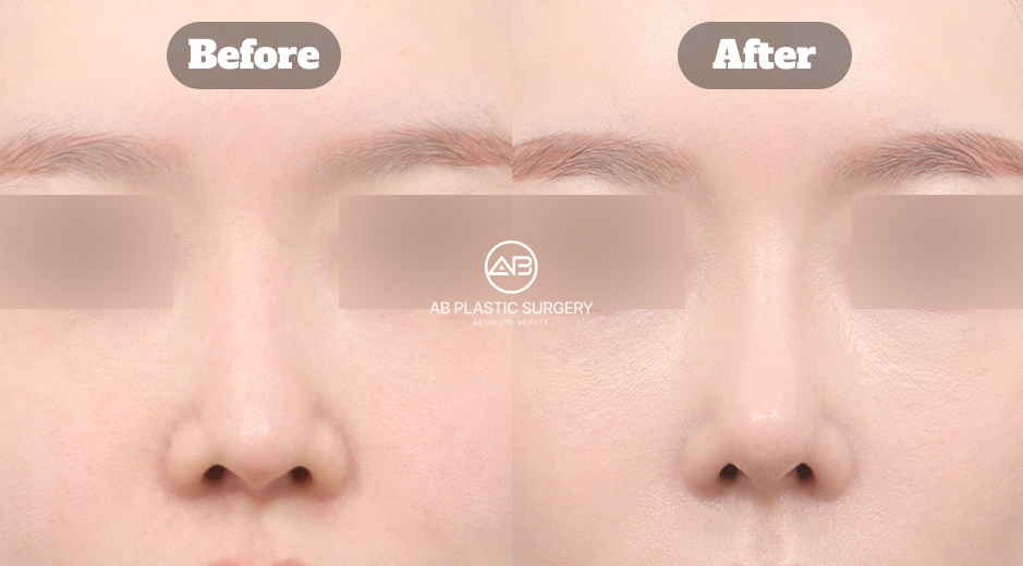 韓国で行われる総合的な鼻整形において、再手術や曲がった鼻、団子鼻、長い鼻、鼻唇角の調整、呼吸機能を考慮した機能的改善までを一括して診断・治療するアプローチを示した説明イメージ