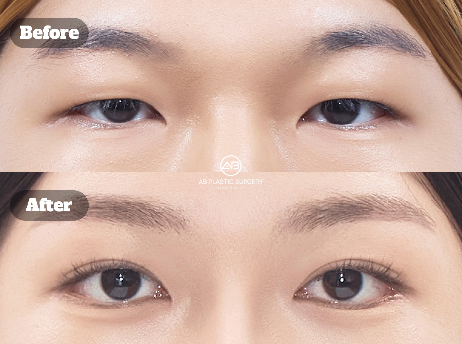 韓国で受けた目頭切開・下眼瞼下制・目尻切開のビフォーアフター写真と体験レビュー