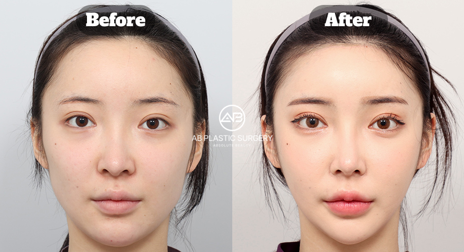 ミニVライン形成におけるダウンタイムと回復期間、日常生活への影響を説明するビフォーアフター画像