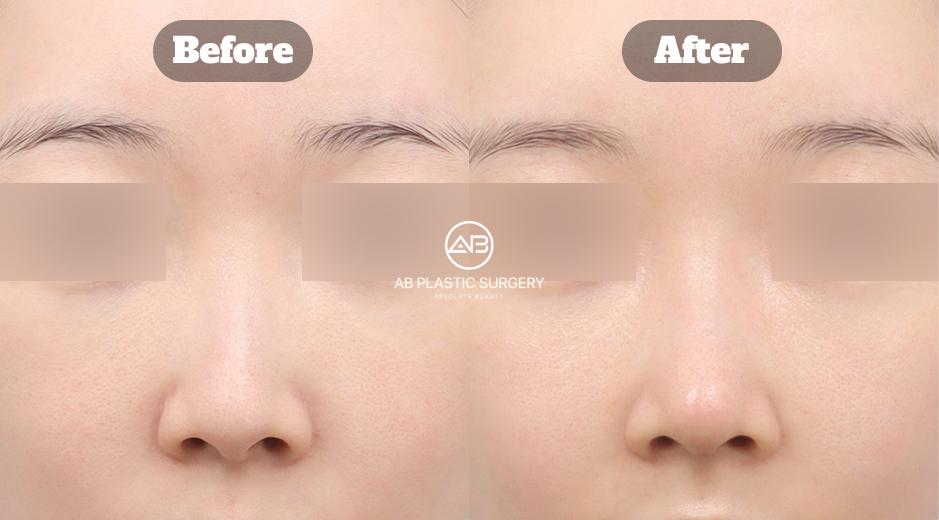 AB美容外科韓国で行われる鼻整形において、再手術や短い鼻、曲がった鼻の矯正を自家軟骨を用いて行い、構造的安定性と機能面まで考慮した治療アプローチを示す説明イメージ