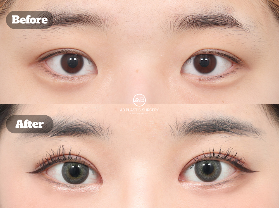 韓国で行った目元再手術と目頭切開・非切開眼瞼矯正のビフォーアフター写真