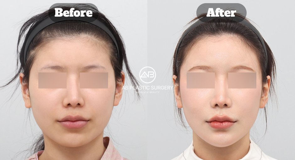 ミニVライン形成に関するよくある質問を理解するための顎ラインのビフォーアフター参考画像