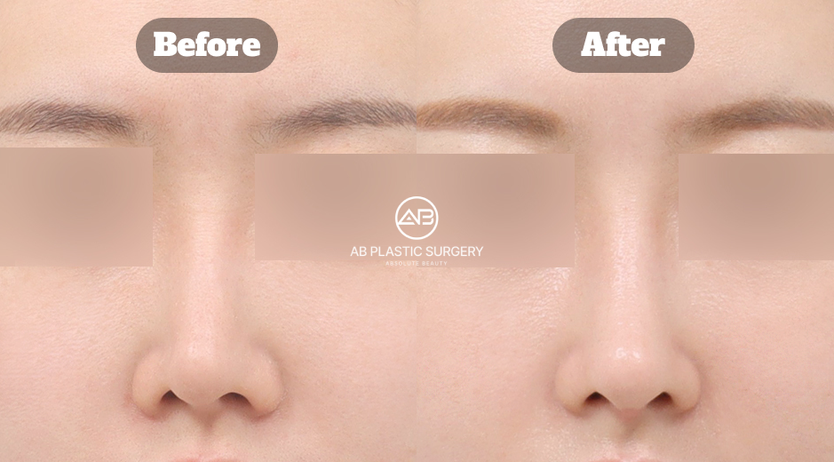 AB美容外科韓国で行われた曲がった鼻の矯正手術について、術前後の変化と実際の患者レビュー・体験談を通じて、鼻の歪みがどのように改善されたかを示す症例イメージ