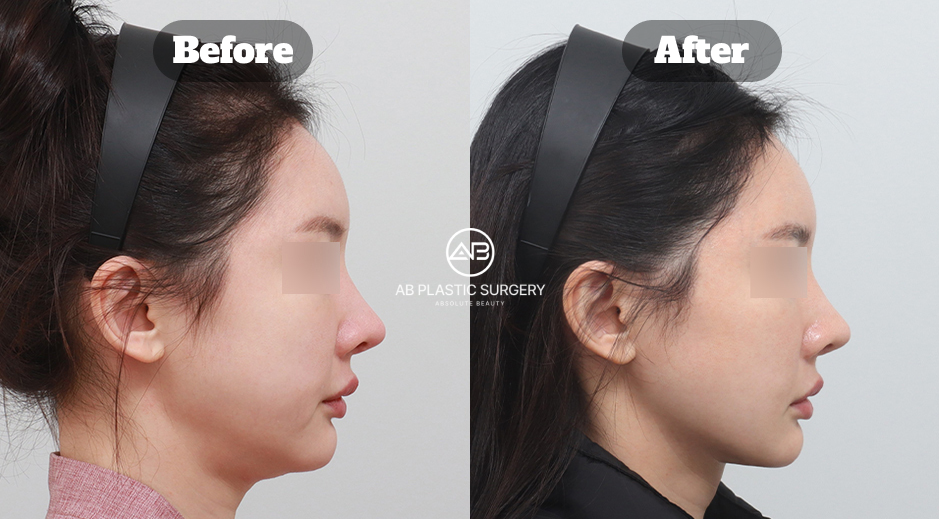 韓国江南にあるAB美容外科で行った二重顎筋肉固定・脂肪吸引・唾液腺除去の施術前後比較写真