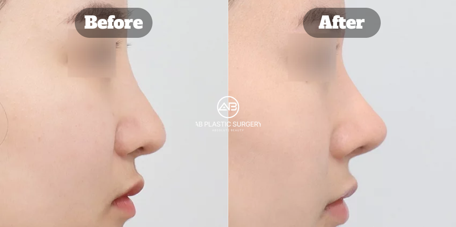 鼻が長く見えるケースで鼻先位置と鼻唇角を調整し長さを短く見せた韓国AB美容外科の鼻整形症例