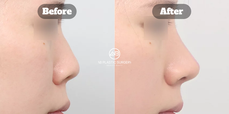 鼻唇角を小さくし鼻先を下げることで口元と人中のバランスを整えた韓国AB美容外科の鼻整形症例