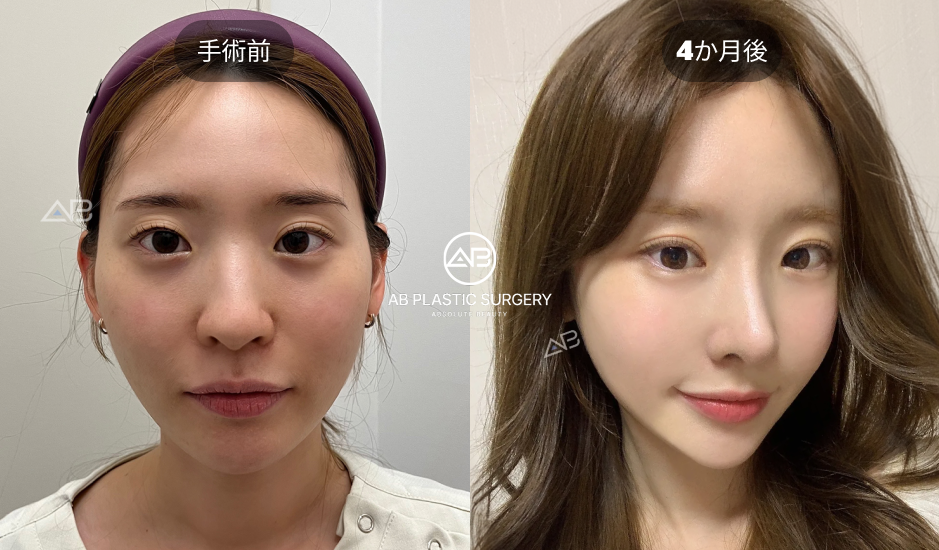 韓国AB美容外科で行われた埋没法による目元再手術の術前と術後4か月の症例写真