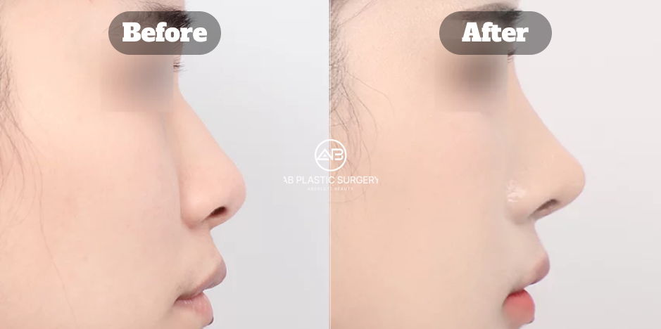 顔全体のバランスに合わせて自然な印象に整えた韓国AB美容外科の鼻整形ビフォーアフター症例