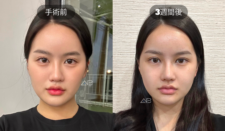 韓国AB美容外科の埋没法二重整形 手術前と3週間後の比較写真