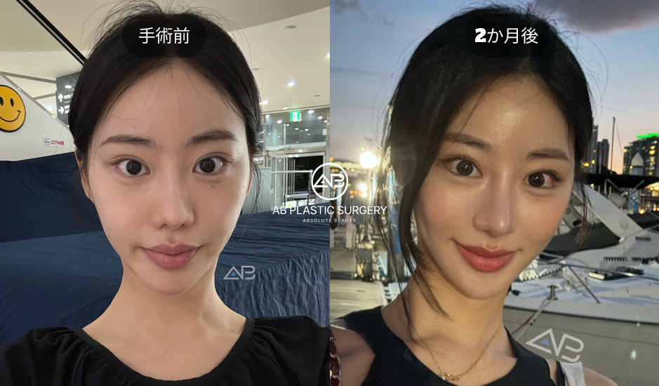 韓国AB美容外科で行われた目尻切開と下眼瞼下制術の術前と術後2か月の症例写真