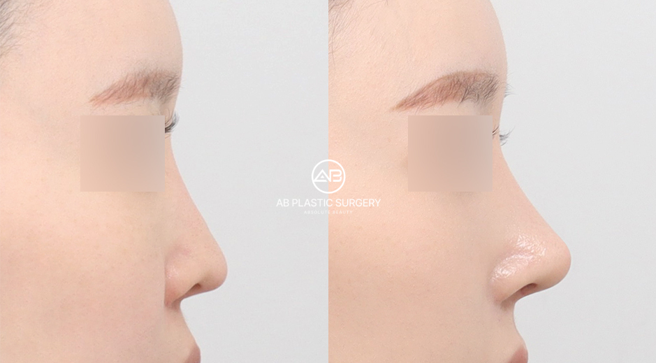 団子鼻に対して骨切りと耳介軟骨を用い機能面にも配慮して整えた韓国AB美容外科の鼻整形ビフォーアフター症例