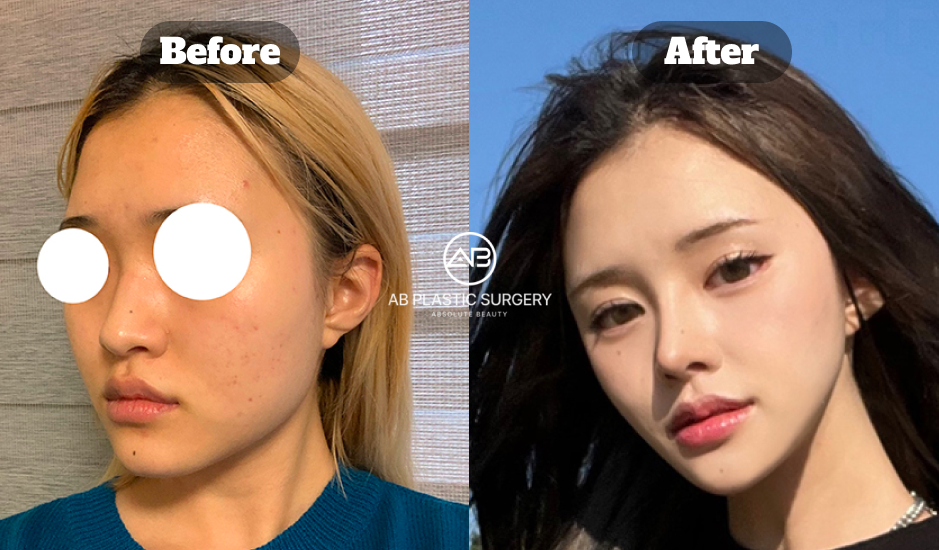 韓国AB美容外科で行ったエラ・頬骨・顎先削りと脂肪移植の施術前後写真