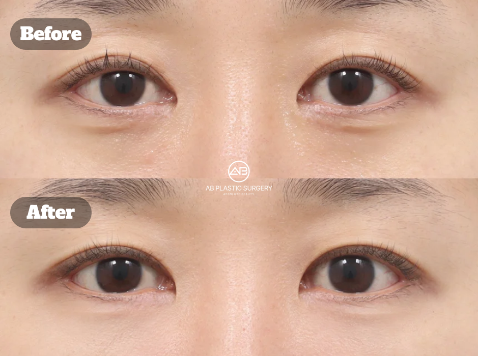 韓国AB美容外科で行われた目の下脂肪再配置手術の術前と術後1か月の症例写真
