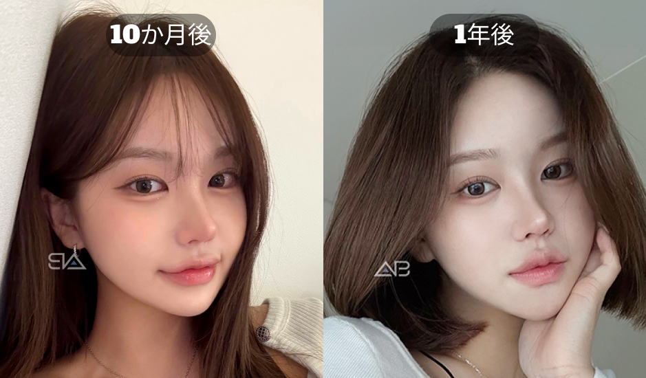 韓国AB美容外科の埋没法二重整形 10か月後と1年後の経過写真