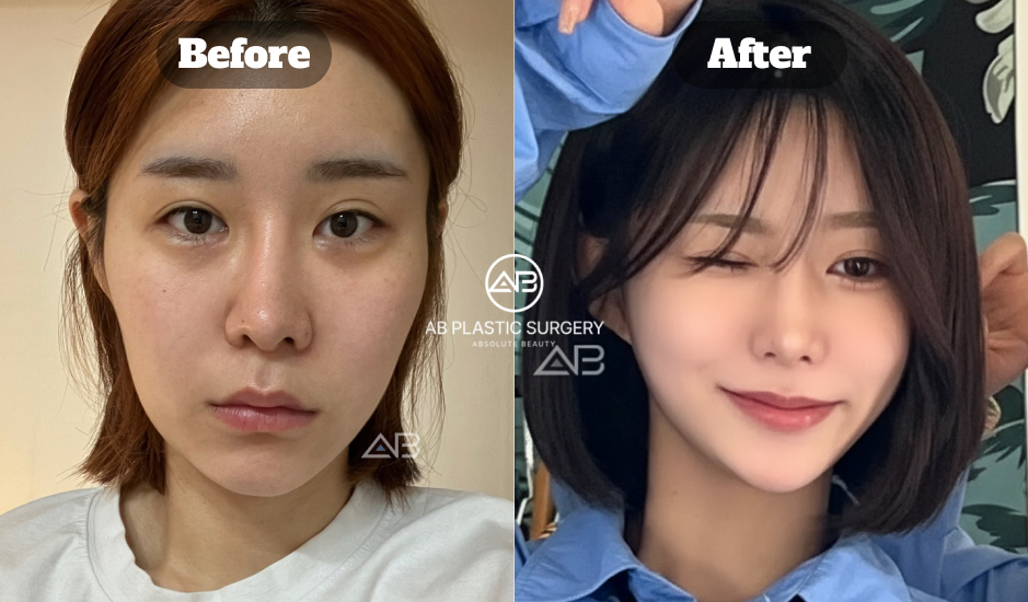 韓国AB美容外科で行われた目元再手術の術前と術後を比較した症例写真