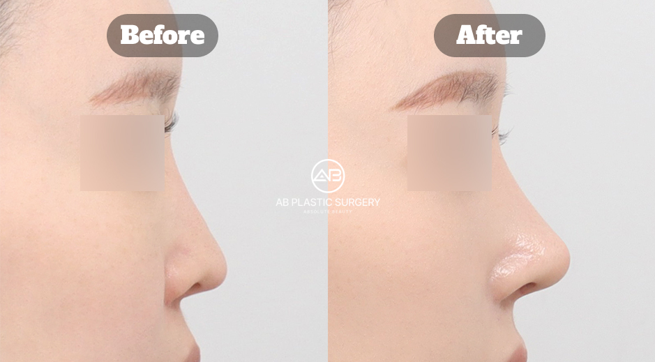 再手術として曲がった鼻や団子鼻・長い鼻を鼻唇角調整と機能改善まで考慮して整えた韓国AB美容外科の鼻整形症例