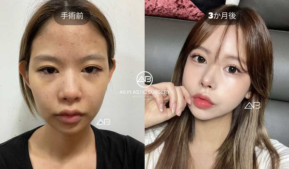 韓国AB美容外科で行われた目元整形の術前と術後3か月を比較した症例写真