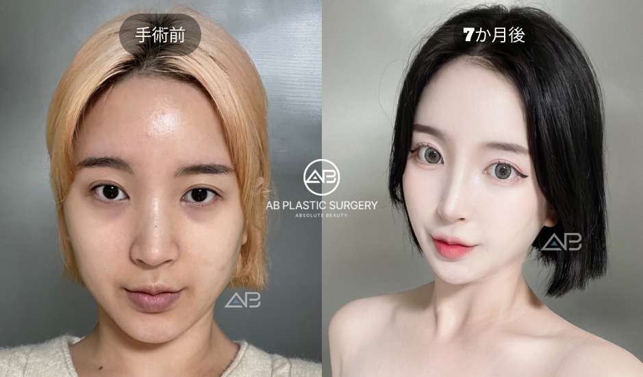 韓国AB美容外科で行われた目元整形の術前と術後7か月を比較した症例写真