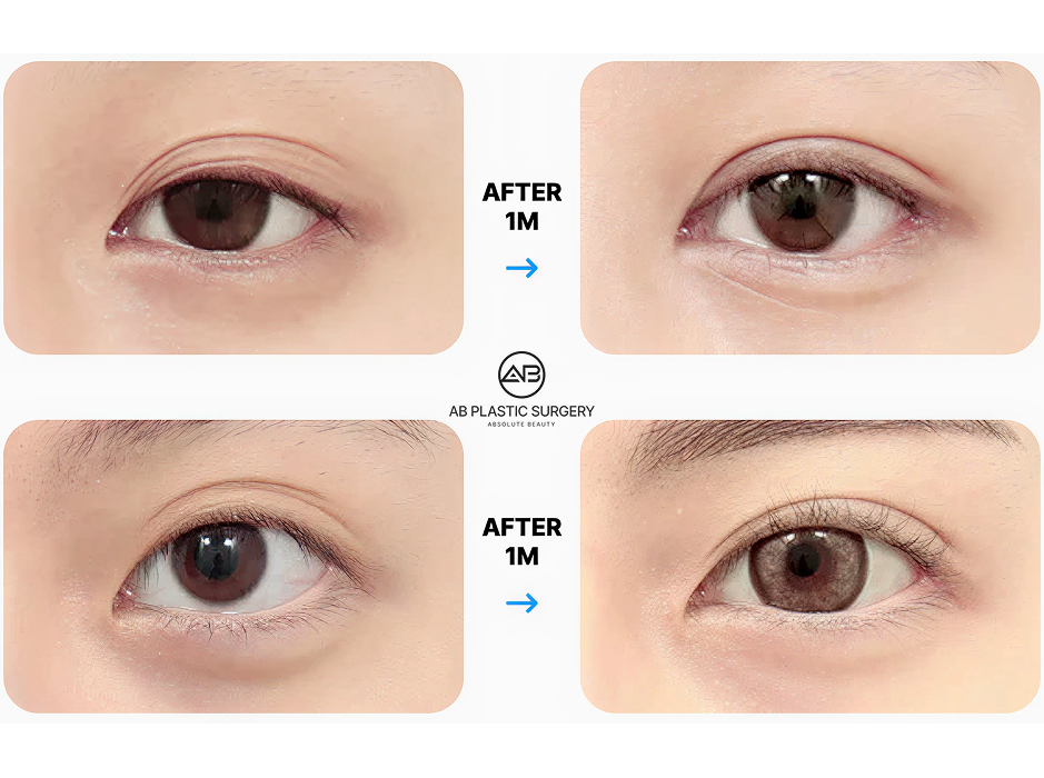 韓国AB美容外科韓国で行われた二重切開法の切開法による二重整形1ヶ月後の症例比較