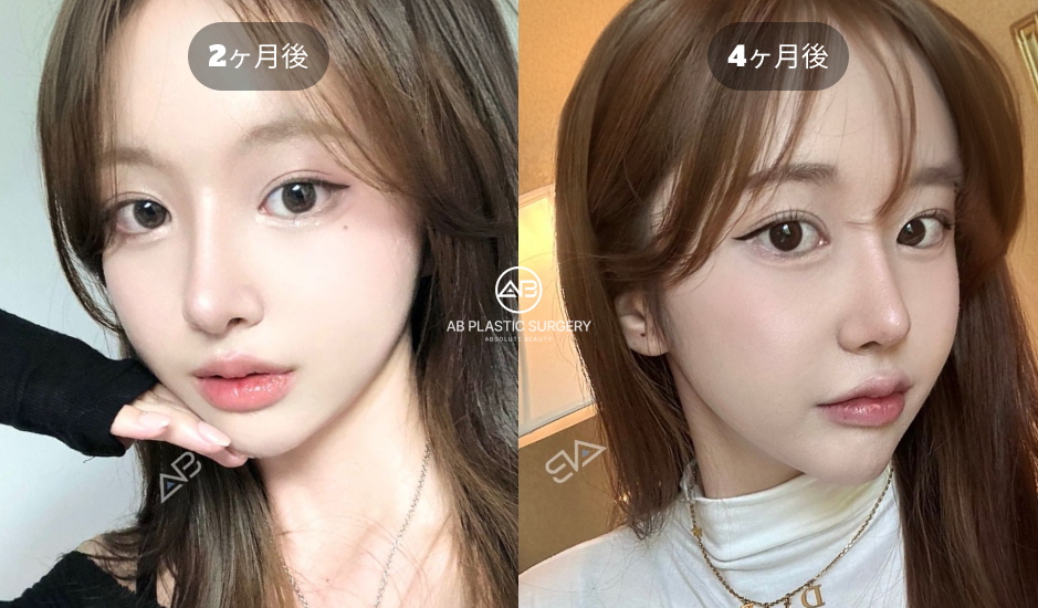 韓国AB美容外科韓国で行われた二重切開法の切開法による二重手術後2ヶ月から4ヶ月までの経過症例
