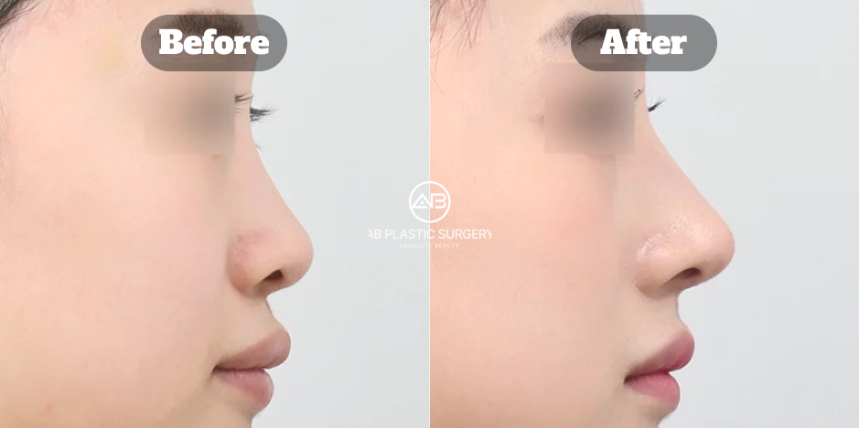 韓国AB美容外科 鼻唇角を広げ鼻先を高めた横顔前後症例