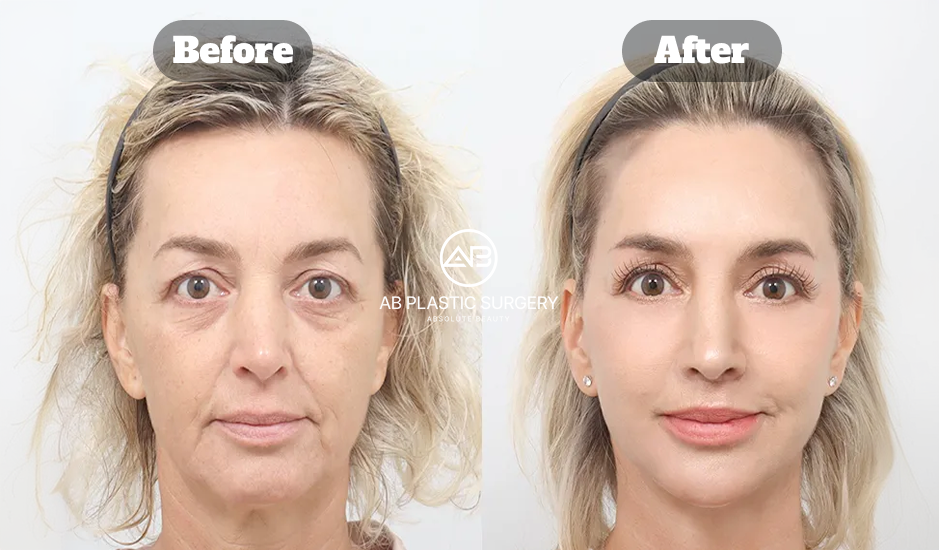 目の下たるみを改善したフルフェイスリフト・ネックリフト・上眼瞼手術・眉リフト・脂肪移植の症例写真