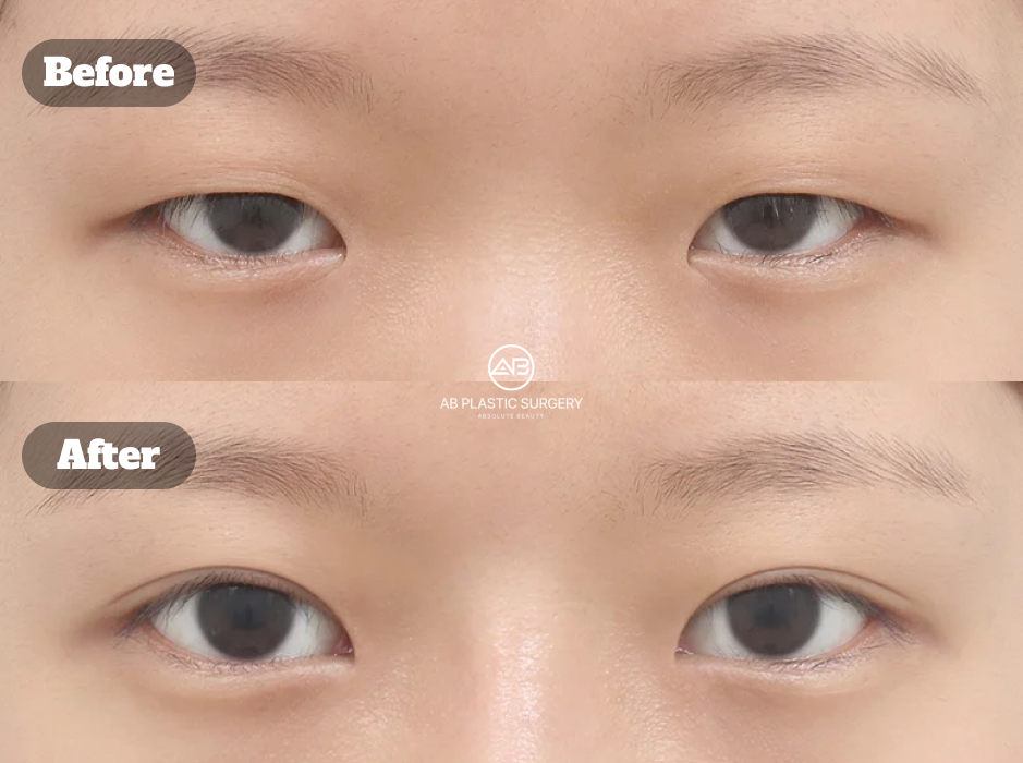 韓国AB美容外科韓国で行われた二重切開法の部分切開と目頭切開・目尻切開・下眼瞼拡張を併用した切開法による二重整形のビフォーアフター