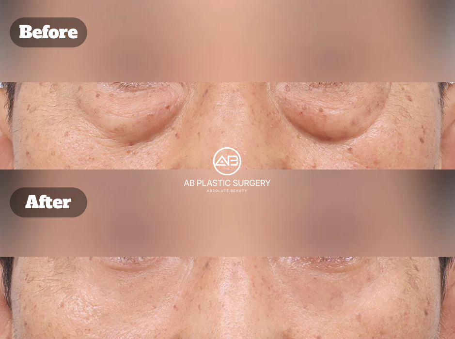 目の下のたるみ解消の為に脂肪除去した下眼瞼手術の症例（術後1ヶ月・韓国 AB美容外科）