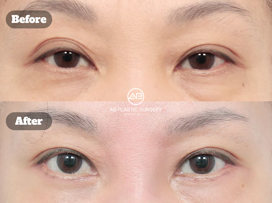 目の下たるみに対して皮膚と脂肪を調整した下眼瞼手術のビフォーアフター（術後1ヶ月・韓国 AB美容外科）