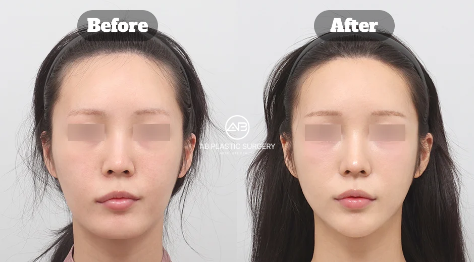 顔が四角い骨格を改善するエラ削りと顎先形成の輪郭手術症例