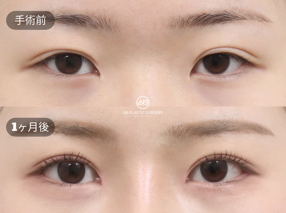整形ダウンタイム症例：目頭切開・目尻切開・下眼瞼拡大の術前と術後1ヶ月の変化