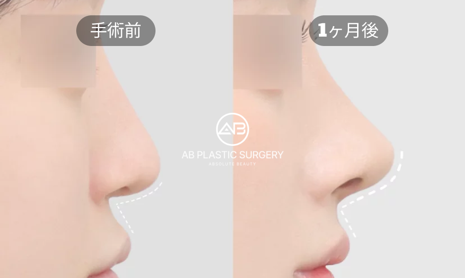 整形ダウンタイム症例：韓国鼻整形の術前と術後1ヶ月の回復変化