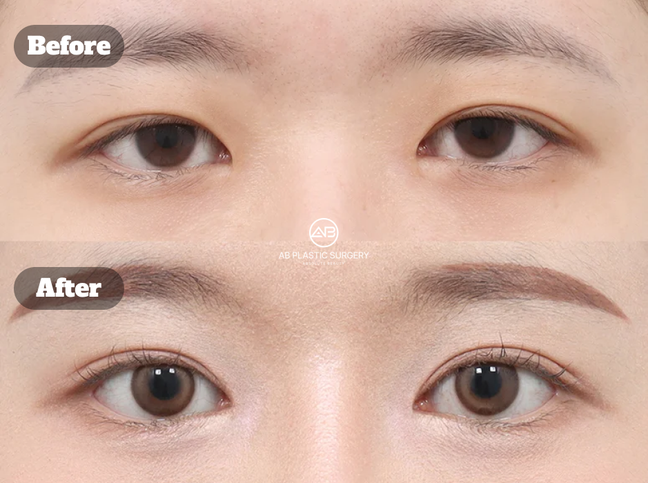 韓国AB美容外科韓国の二重切開法再手術で切開法による二重デザインと二重ラインを改善したビフォーアフター
