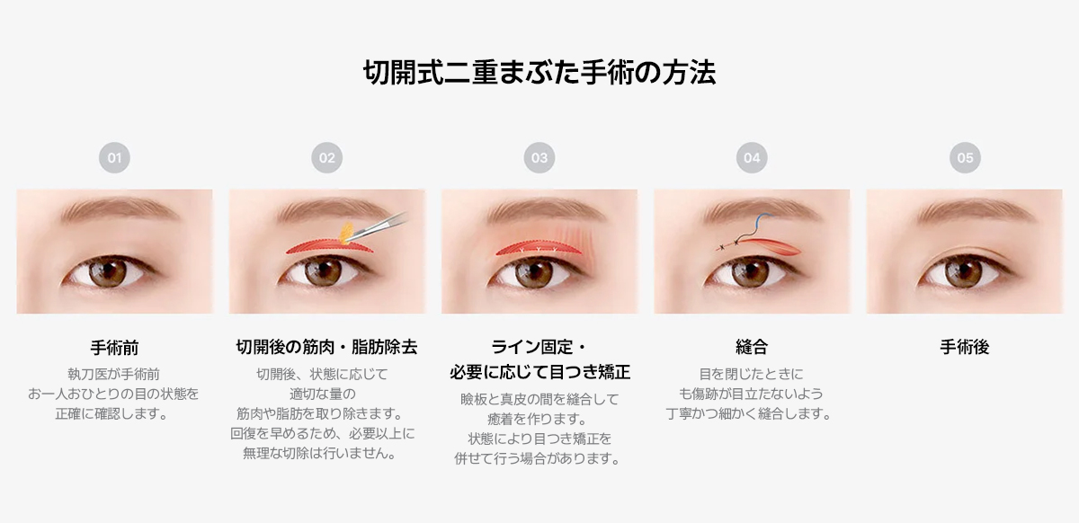 二重整形の方法の比較