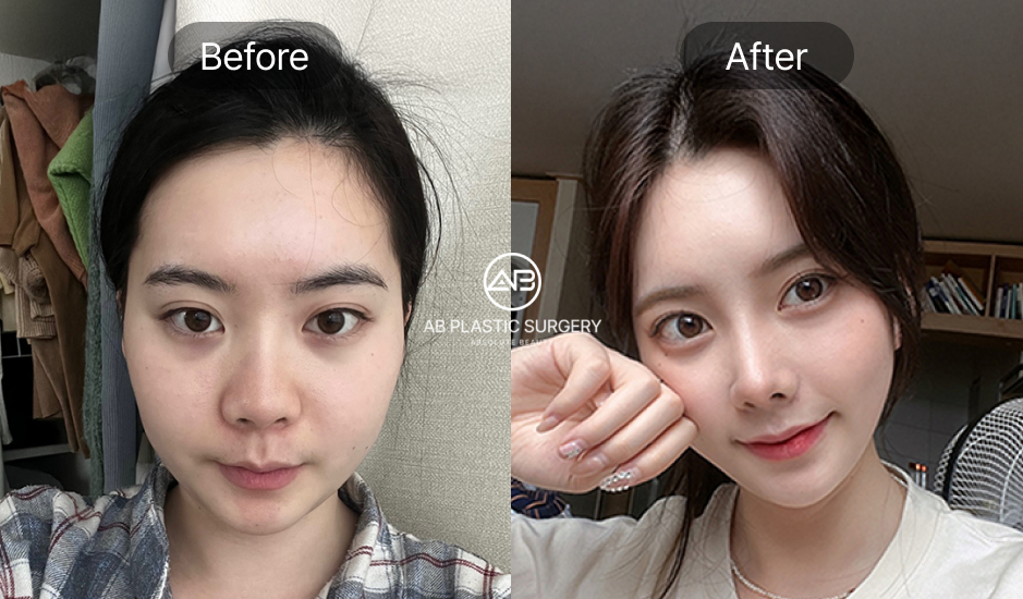 ぶた鼻を改善するため自然な鼻バランスが考えられた症例（韓国 AB美容外科）
