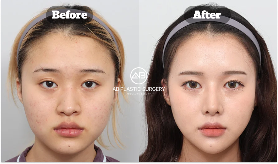 黄金比の顔バランスを考慮し全体の調和を改善した女性のビフォーアフター症例（韓国 AB美容外科）