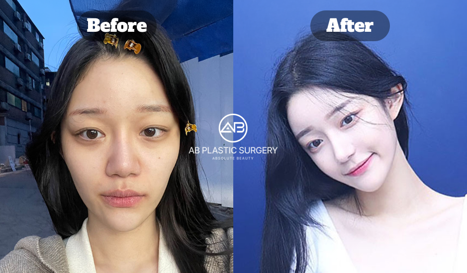 バレない整形で輪郭と鼻のバランスを整え自然な仕上がりに満足した女性のビフォーアフター（韓国 AB美容外科）