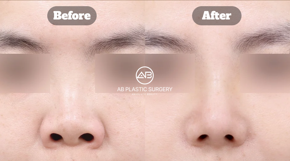 ぶた鼻を改善するため短鼻矯正・鼻骨骨切り・鼻中隔角度調整を行った鼻整形のビフォーアフター