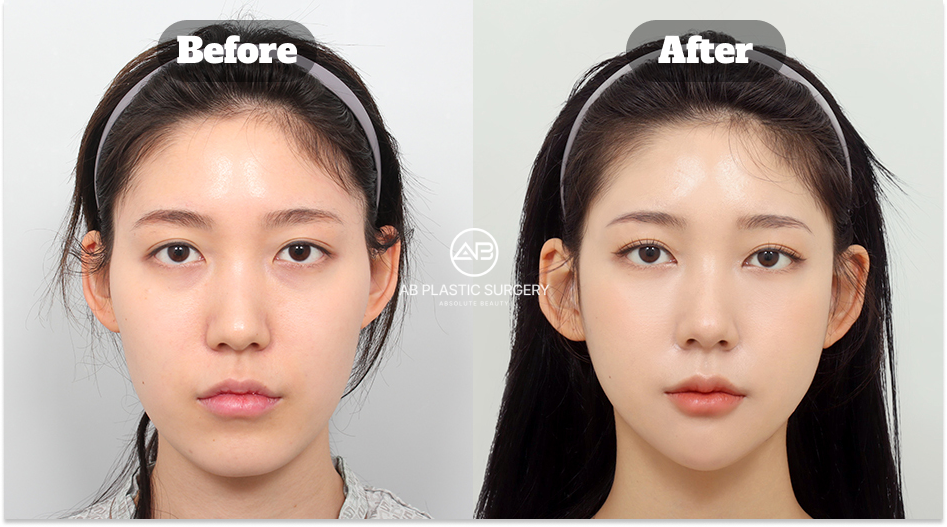 バレない整形の条件を満たし周囲に気づかれにくい自然な変化を実現したビフォーアフター症例（韓国 AB美容外科）