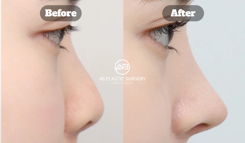 ぶた鼻を改善するため短い鼻を延長し鼻先と鼻筋のバランスを整えた鼻整形の側面ビフォーアフター（韓国 AB美容外科）