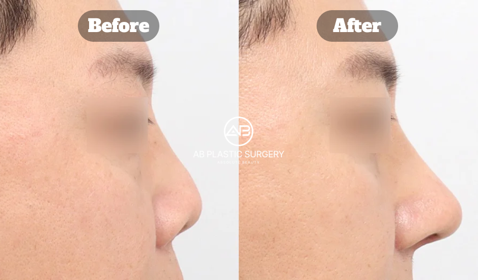 ぶた鼻を改善するため再手術・短鼻矯正・小鼻縮小・機能鼻手術・自家肋軟骨を用いた鼻整形の側面ビフォーアフター（術後1ヶ月・韓国 AB美容外科）