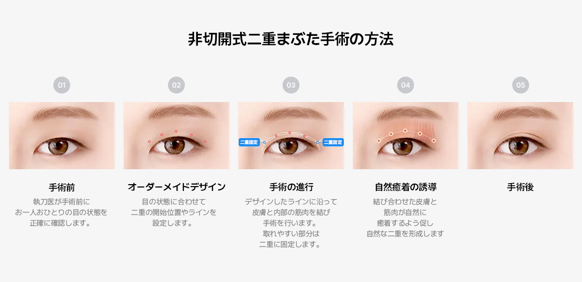 自然癒着と埋没法と非切開の関係