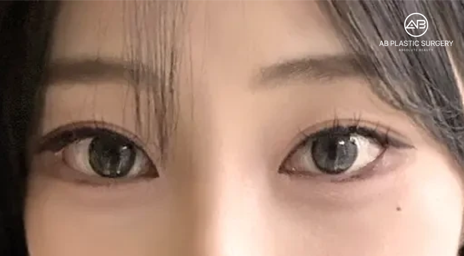 二重の始点が蒙古ひだから離れ、くっきりしたラインが特徴のアウトライン型平行二重デザイン例