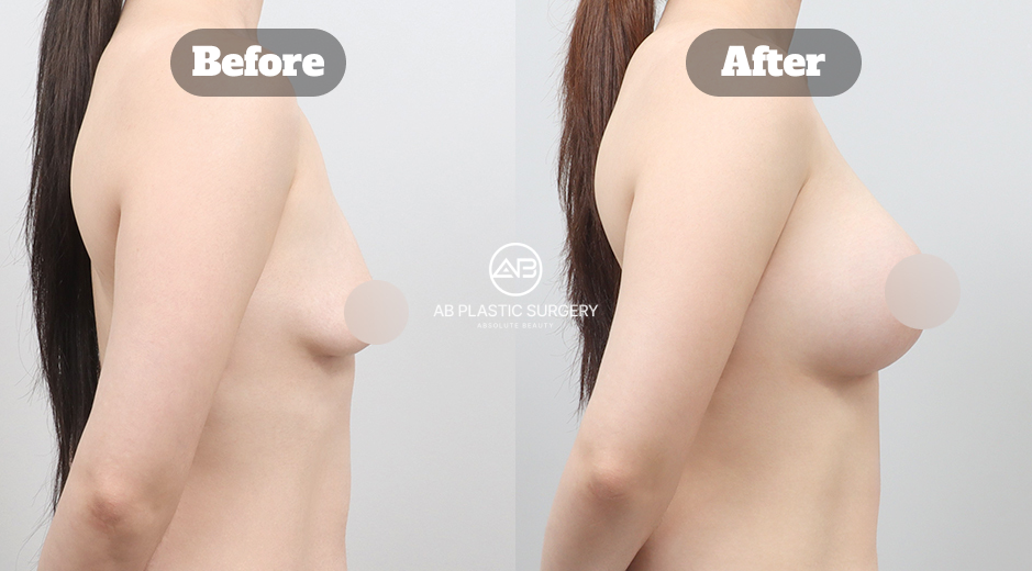 AB美容外科韓国のMentorシリコン豊胸による垂れ乳改善症例のビフォーアフター写真
